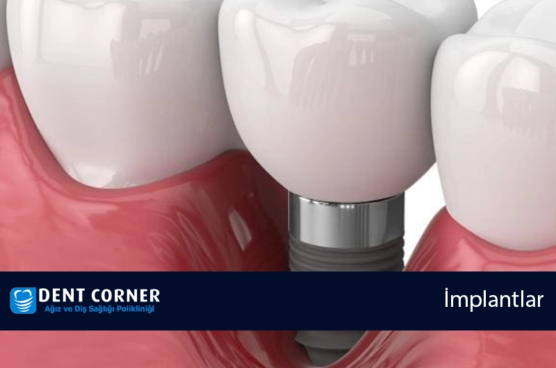 İmplant Markaları 2025