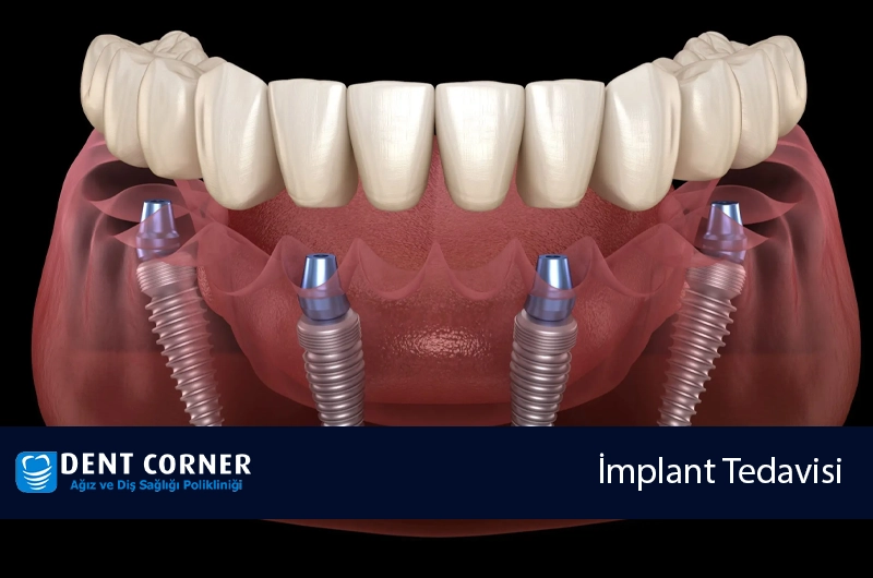 İmplant Tedavisi Nasıl Yapılır? Çeşitleri Nelerdir?