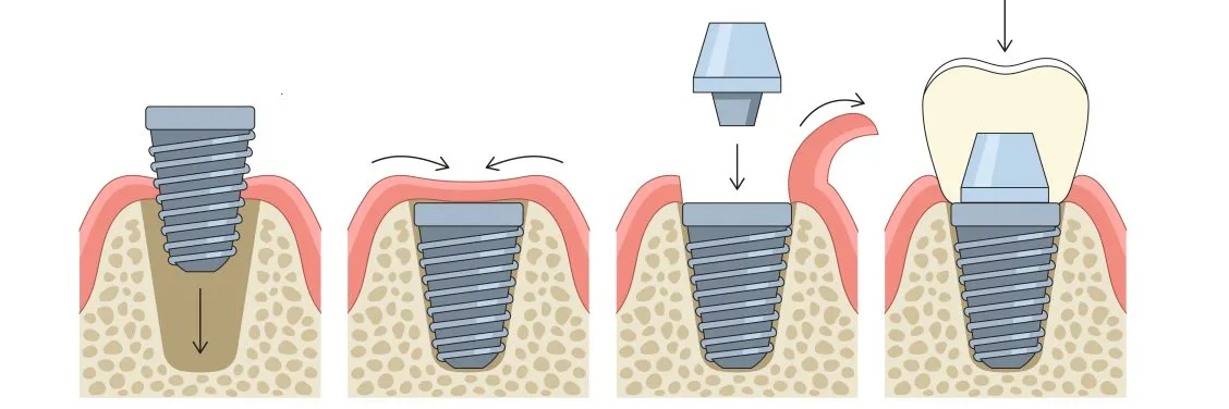 İmplant nasıl uygulanır? İmplant uygulama aşamaları