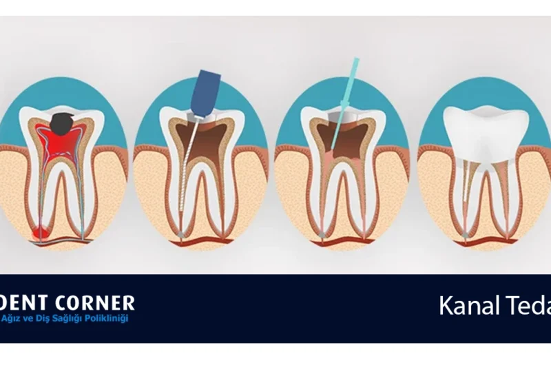Kanal Tedavisi Nedir? Kanal Tedavisi Sonrası Ağrı ve Detaylar