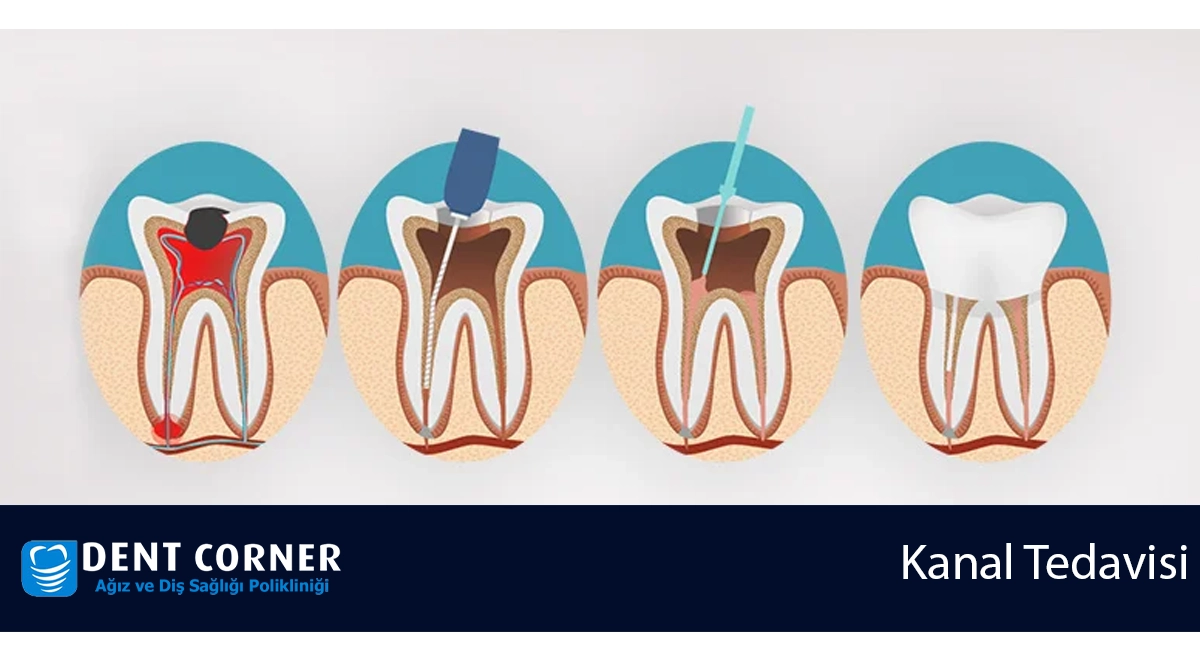 Kanal Tedavisi Nedir? Kanal Tedavisi Sonrası Ağrı ve Detaylar