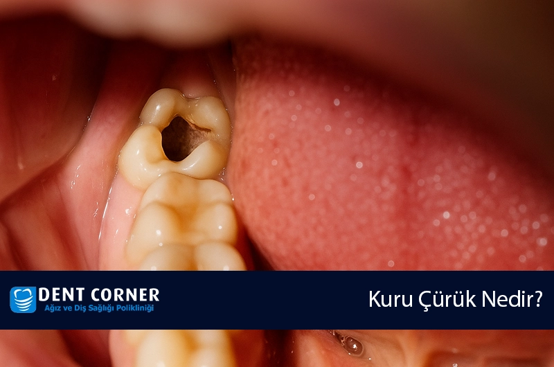 Kuru Çürük Nedir? Tedavi Yöntemleri ve Önleme İpuçları