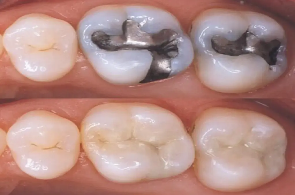 organik diş dolgusu