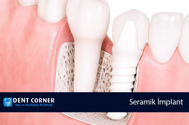 Seramik İmplant Nedir ve Nelerden Yapılır?