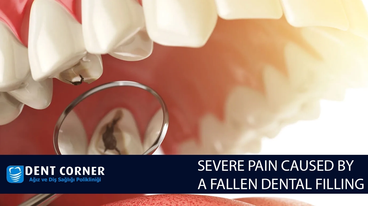 SEVERE PAIN CAUSED BY A FALLEN DENTAL FILLING