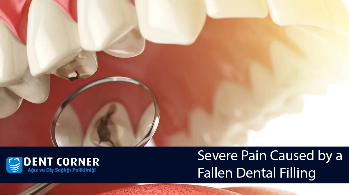 Severe Pain Caused by a Fallen Dental Filling